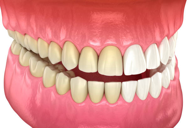 Tratamento: Clareamento dental Tratamento: Clareamento dental