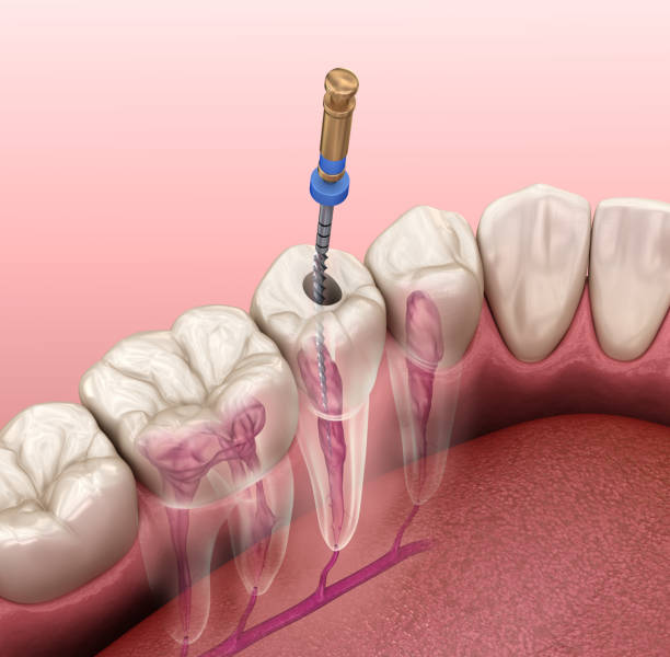 Tratamento: Endodontia Tratamento: Endodontia