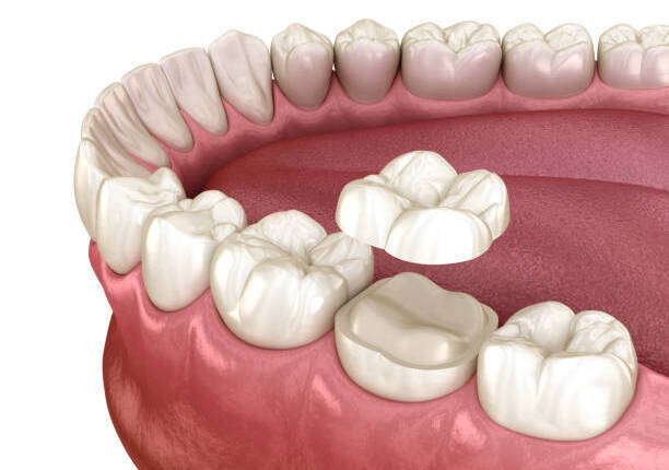 Tratamento: Próteses Tratamento: Próteses